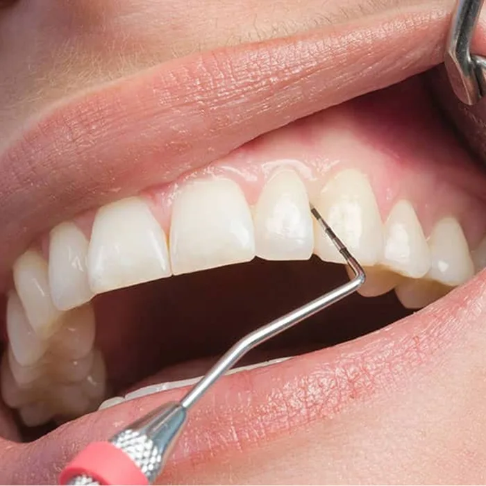 Diş Eti Tedavisi (Periodontoloji)