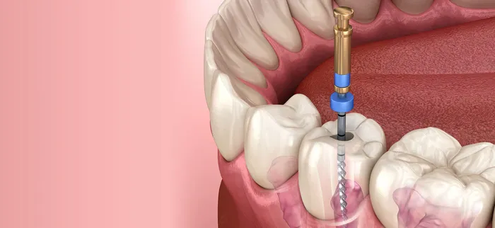 Kanal Tedavisi (Endodonti)