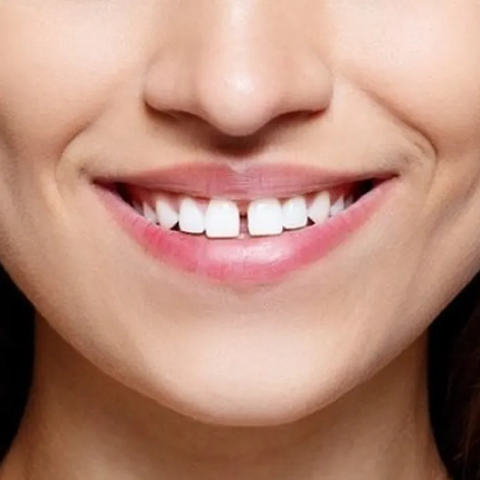 Estetik Dolgu (Kompozit Bonding)