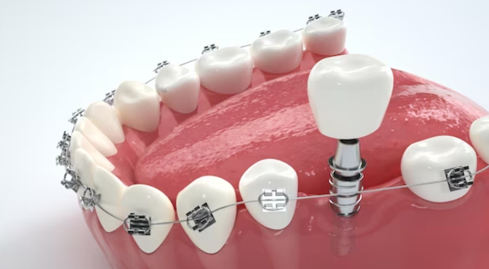 Antalya Dental Tourism, Antalya Implant Treatment, All on Four Implant Treatment and Frequently Asked Questions.