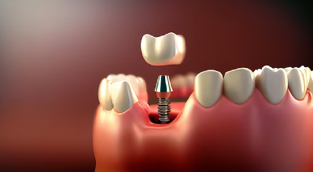 Istanbul Dental Tourism, Norway Implant Treatment, All on Four Implant Treatment and Frequently Asked Questions.