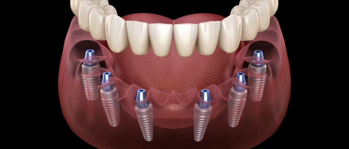 all on 6 implant