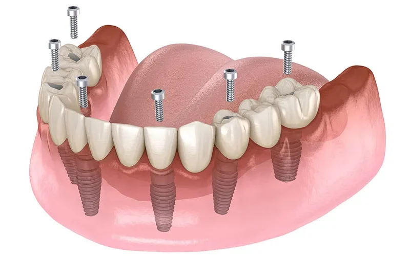 All on Four İmplant Tedavisi Nedir? All on Four İmplant Tedavisi Kimlere Uygulanır?