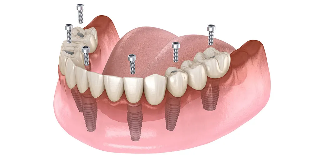 All on Four İmplant Tedavisi Nedir? All on Four İmplant Tedavisi Kimlere Uygulanır?