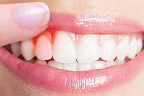 Diş Eti Tedavisi Nedir? Sağlıklı Diş Etleri İçin Aşamaları, Faydaları ve Sık Sorulan Sorular