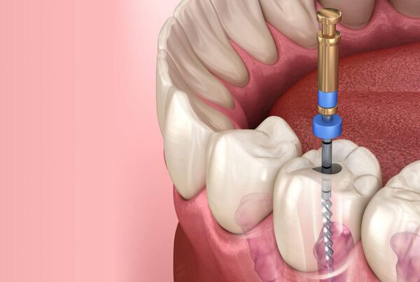 Kanal Tedavisi Nedir? Aşamaları, Avantajları ve Sık Sorulan Sorular