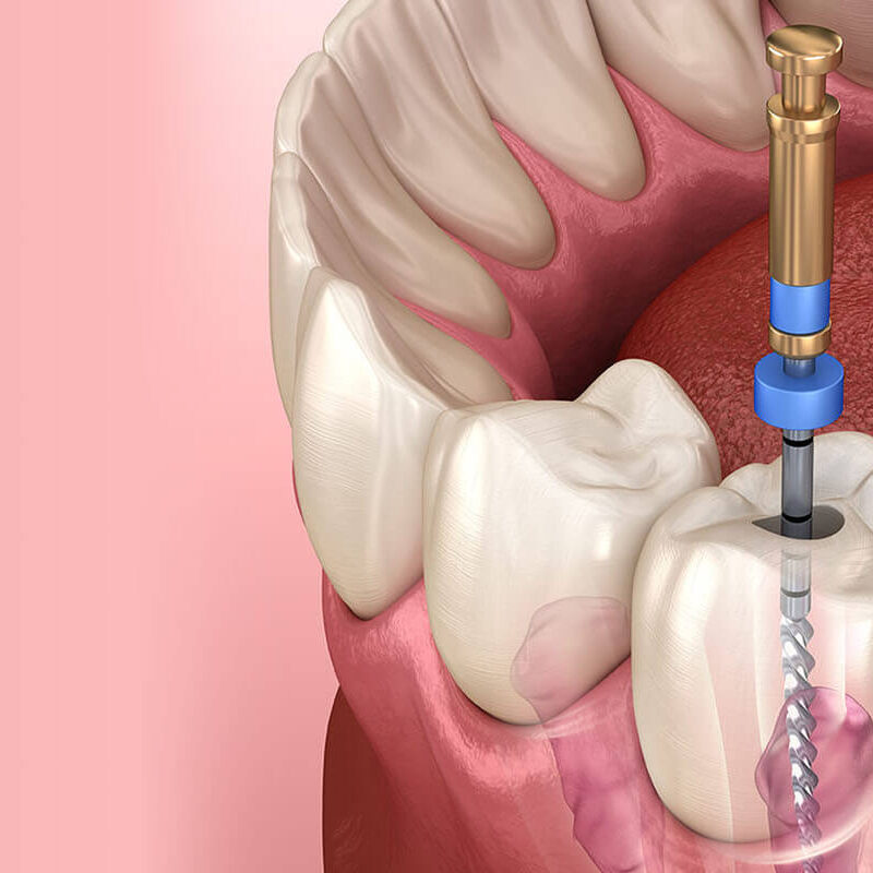 Kanal Tedavisi Nedir? Aşamaları, Avantajları ve Sık Sorulan Sorular