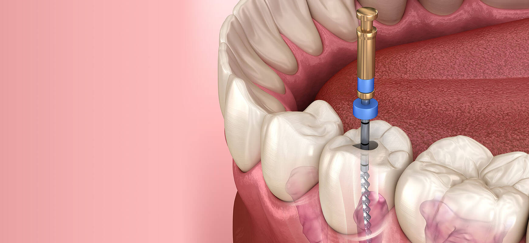 Kanal Tedavisi Nedir? Aşamaları, Avantajları ve Sık Sorulan Sorular