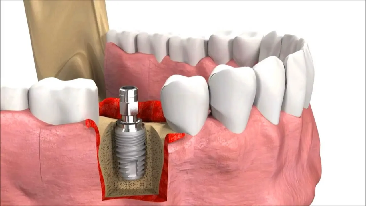 Uygun Diş İmplantı Sultanbeyli İmplant Tedavisi ve Fiyatları