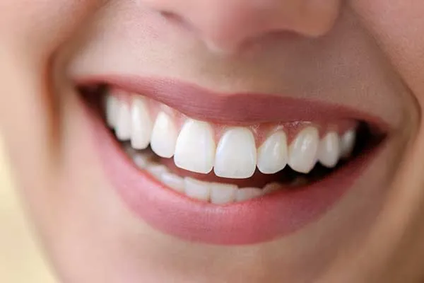 Hollywood Smile, Kağıthane Gülüş Tasarımı, Gülüş Estetiği Tedavisi ve Fiyatları