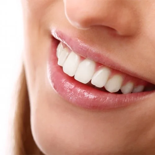 Hollywood Smile Nedir