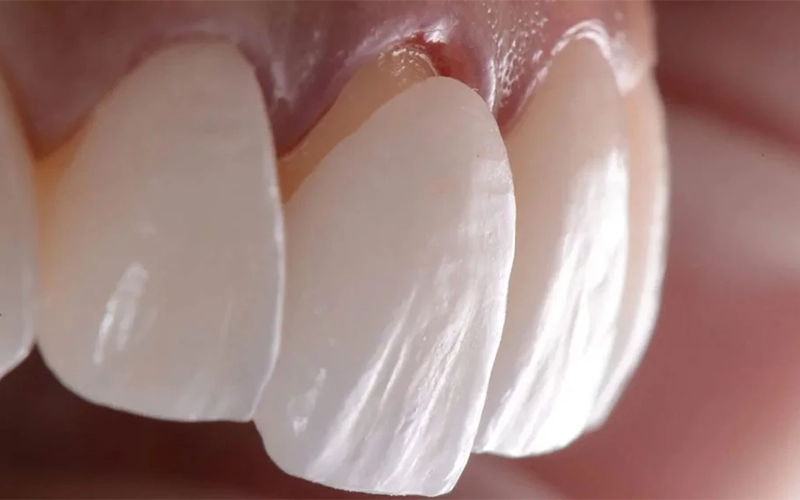 Lamine Veneer Emax Kaplama Nedir